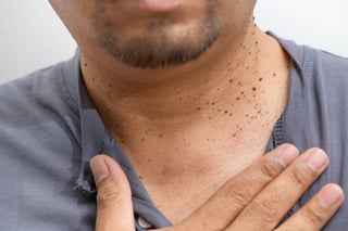 Skin tags on neck benign growths