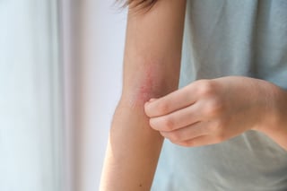 Child with eczema scratching skin