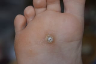 Plantar wart on foot verruca