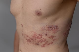 Shingles viral rash with blisters
