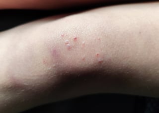 Molluscum contagiosum skin bumps
