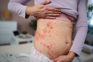Contact dermatitis allergic skin rash