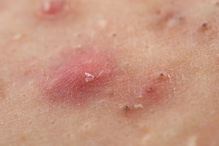 Close-up of acne skin texture with bumps