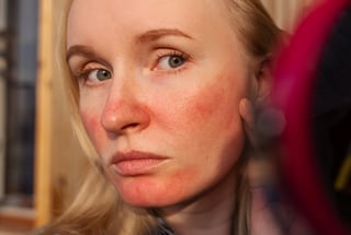 Rosacea facial redness and skin condition