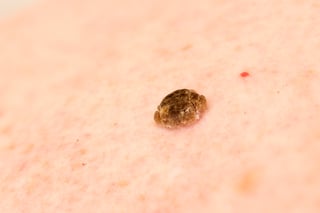 Seborrhoeic keratosis waxy skin growth