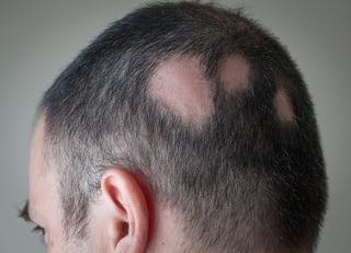 Alopecia areata hair loss patch