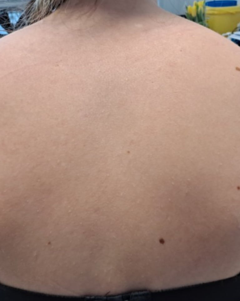 Close-up view of a persons bare back with light skin tone and scattered moles in an outdoor setting