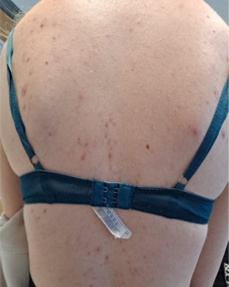 Close-up of back skin showing acne and redness, person wearing black bikini top