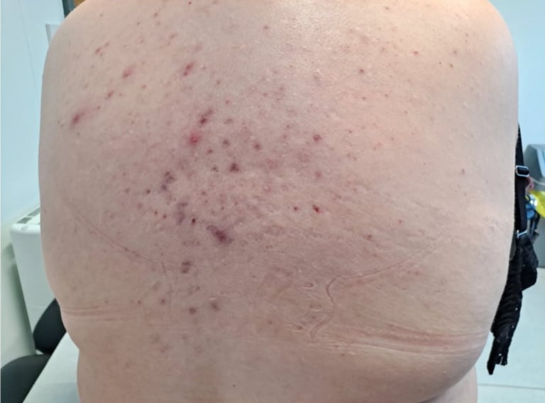 Before treatment - back showing acne blemishes