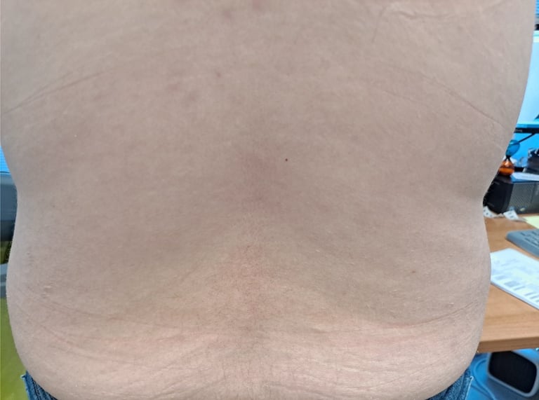 After treatment - clear skin