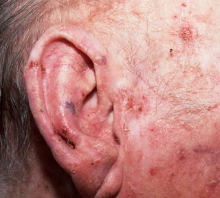 Close-up of ear and surrounding skin showing redness and rash, possibly indicating infection or dermatological condition